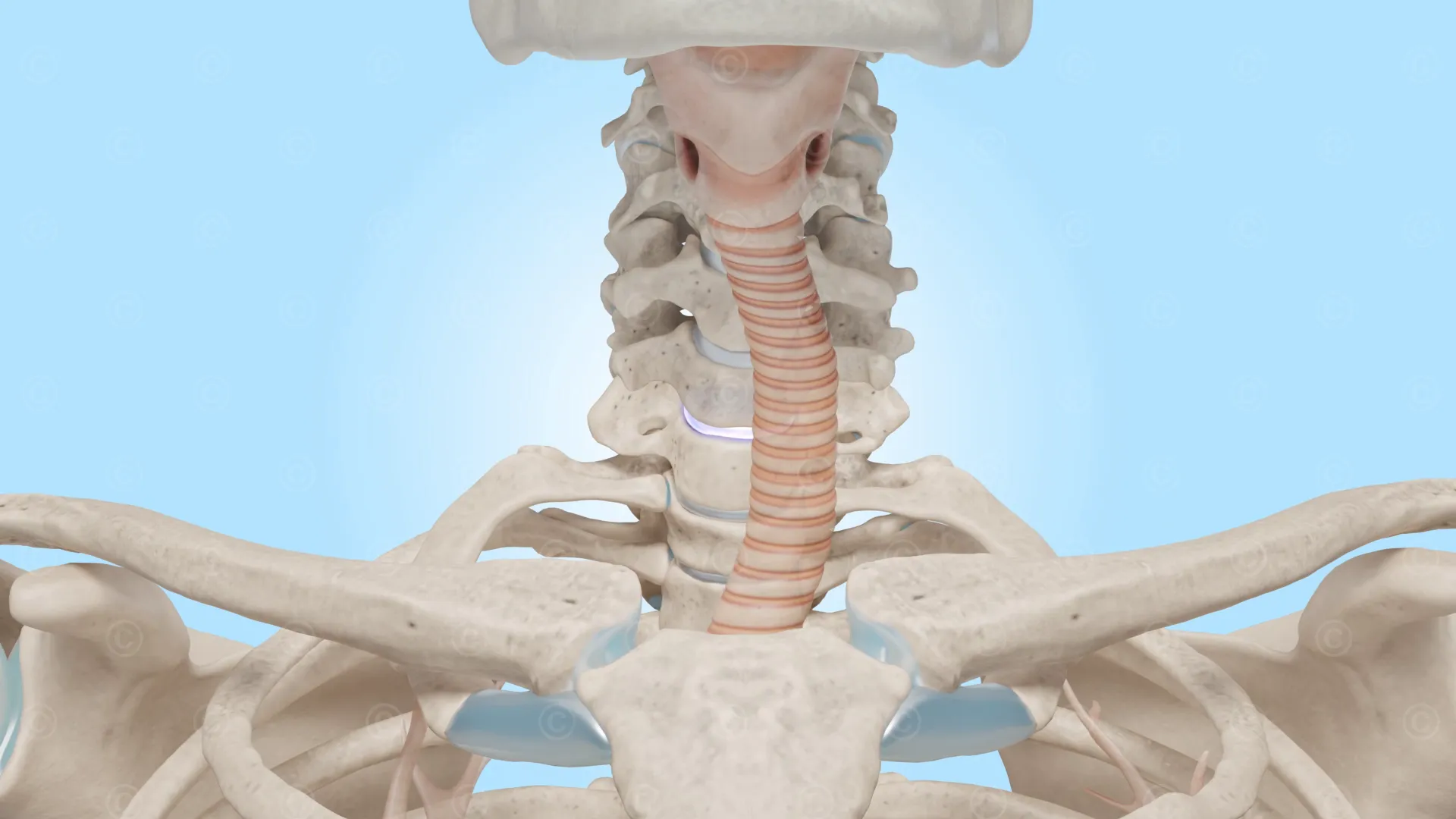 Displace trachea - surgery ACDF
