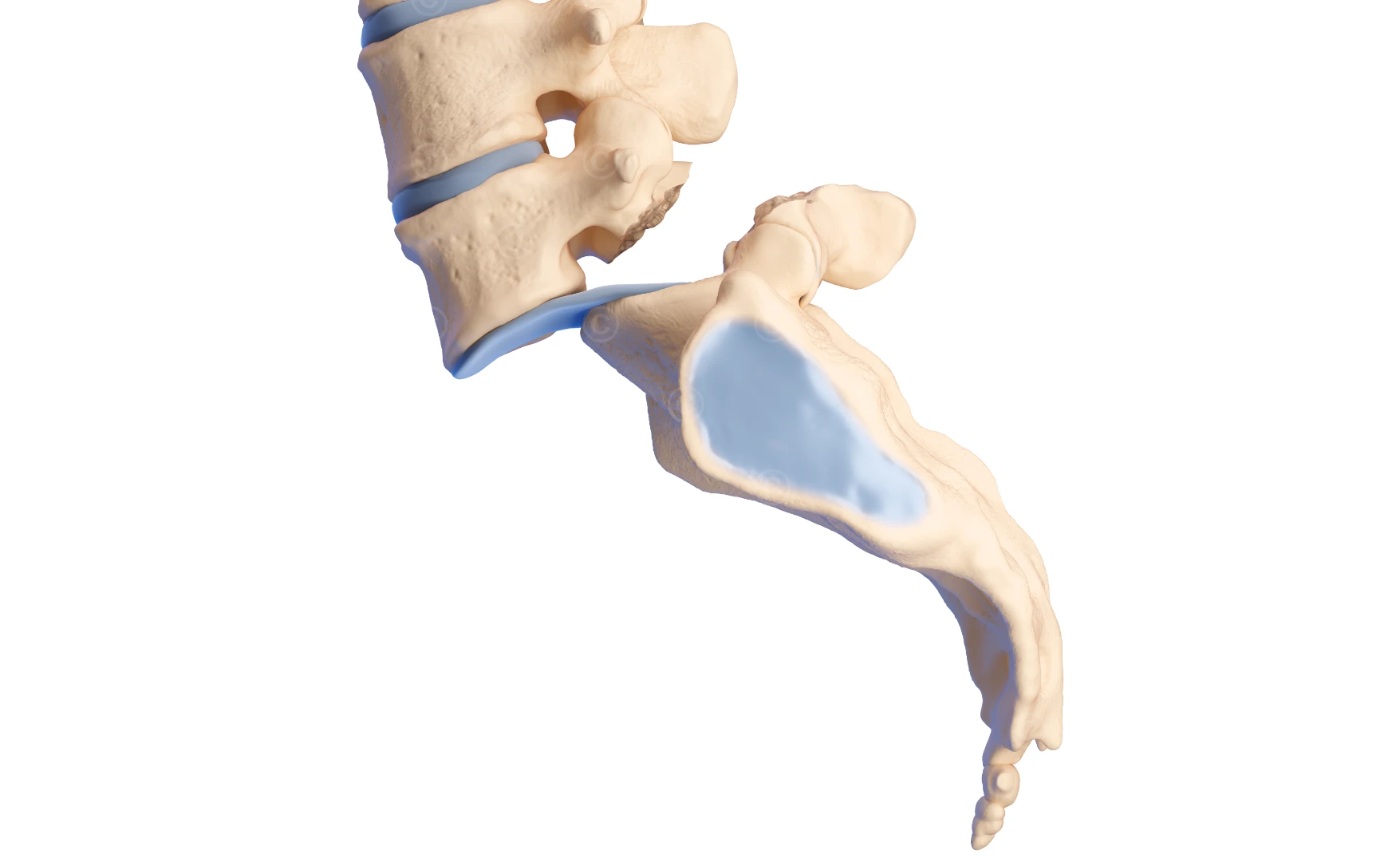 Isthmic pondylolisthesis