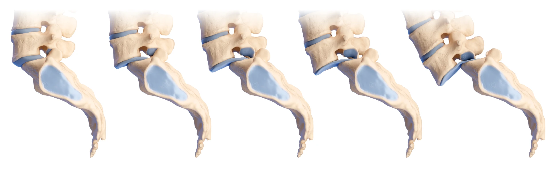 Spondylolisthesis (auch “Wirbelgleiten”)