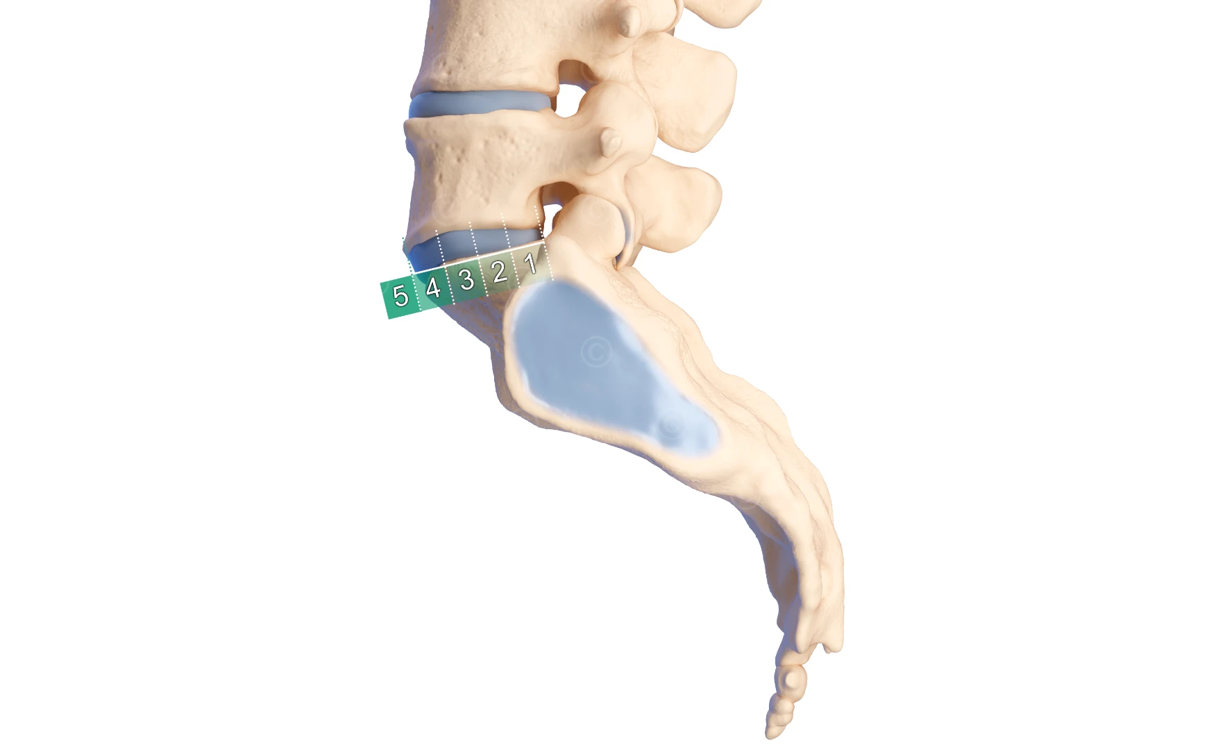 Spondylolisthesis all grades