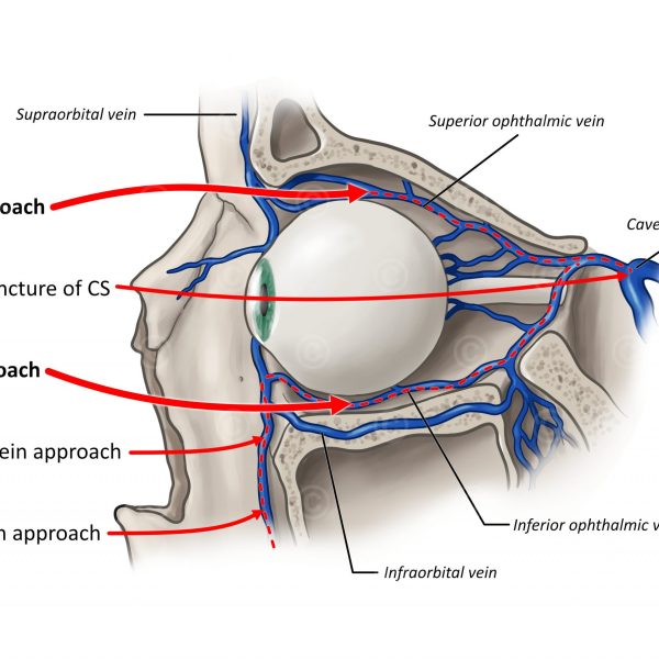 Anatomie des menschlichen Auges mit verschiedenen Zugängen zur Katheterisierung einer Karotisfistel