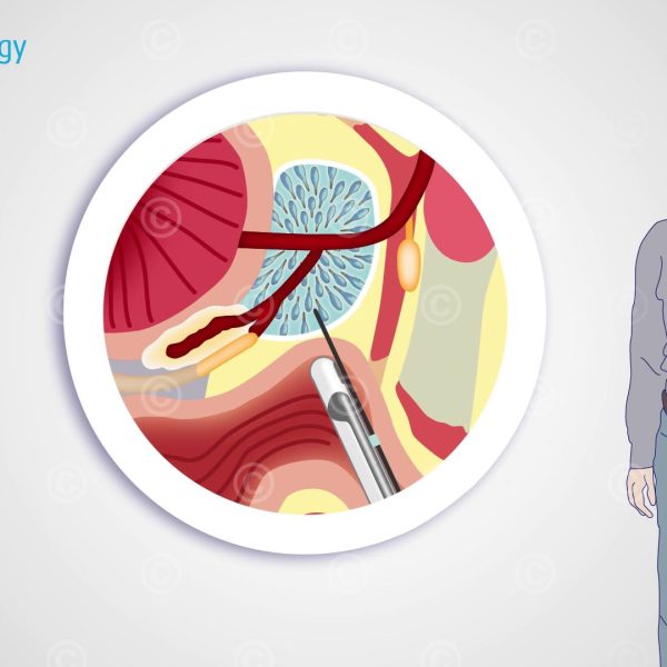 Biopsy Prostate